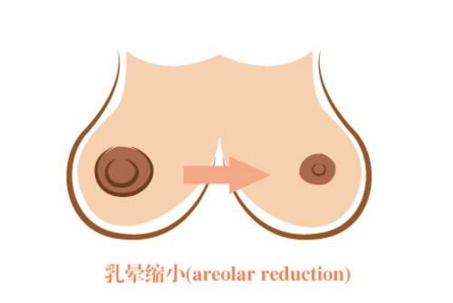 乳晕缩小多久能恢复