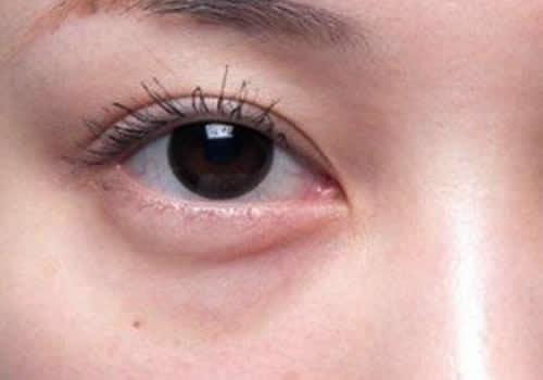 下眼袋浮肿怎么办 去除下眼袋浮肿，其实很简单！