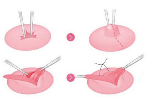 乳晕缩小多少钱