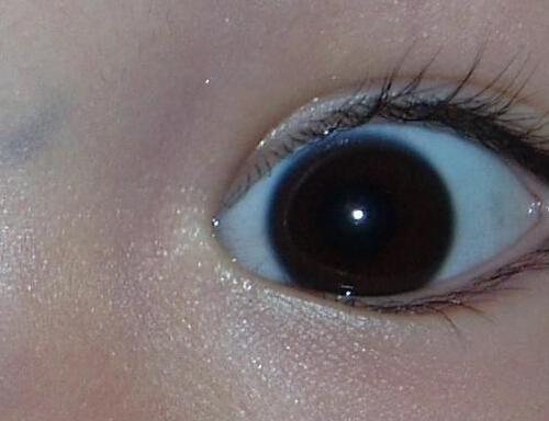 睫毛长到眼睛里怎么办