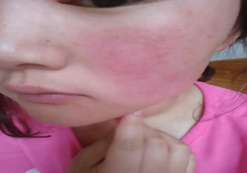 西瓜皮敷脸去红血丝吗 红血丝要谨慎使用西瓜皮敷脸