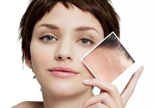 酒刺里面白色的是什么