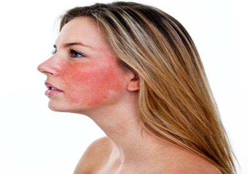 敏感性皮肤的特征 敏感性皮肤的特征、产生原因、修复方法,一应俱全!