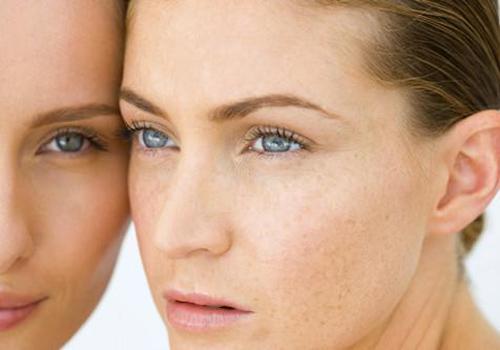 脸上有好多班怎样祛斑 4个方法效果好