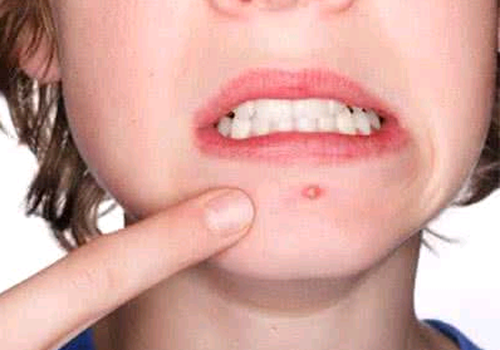 爱长痘痘是什么原因 怎么解决长痘痘