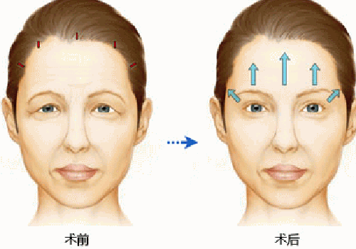 面部拉皮手术后遗症 拉皮手术的危害