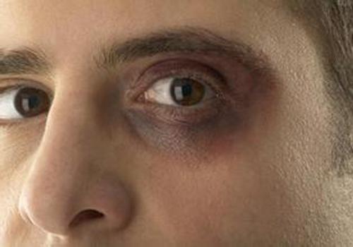 男士黑眼圈怎么去除