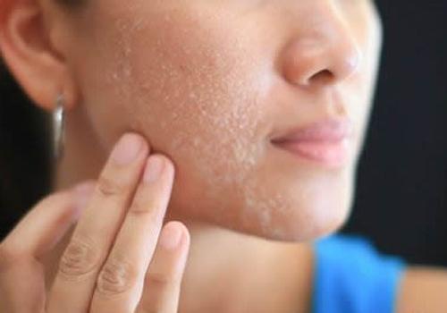 角质层薄能用白醋洗脸吗 角质层薄怎么洗脸