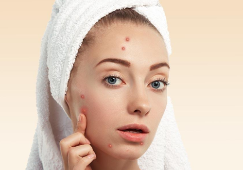 脸上痘痘反复发作怎么办 5招帮你赶走长痘烦恼