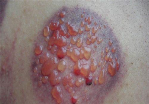 拔火罐起水泡是什么原因