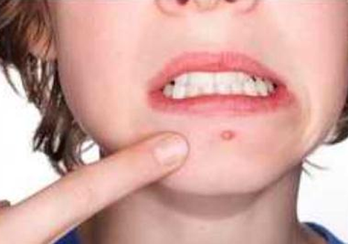 用粉刺针挑粉刺怎么消红最快