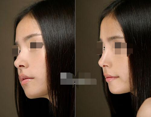 硅胶隆鼻怎么做 硅胶隆鼻过程