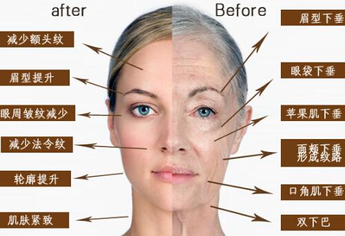 超声刀美容能维持几年 超声刀美容能维持多久