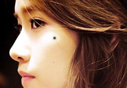 激光点痣会留疤吗