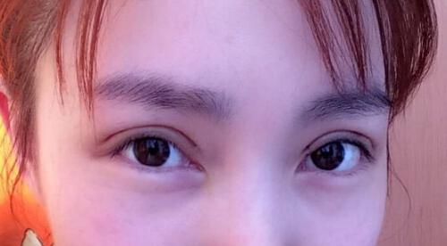 韩式三点双眼皮价格