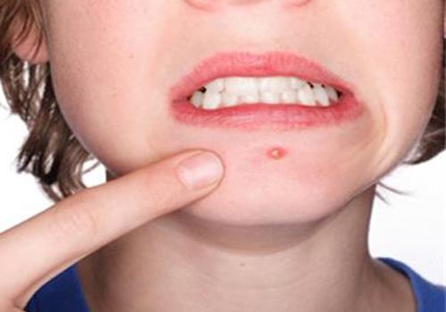 长了粉刺应该怎么处理 9个去除粉刺的小妙招