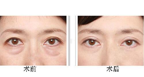 眼袋吸脂后注意事项