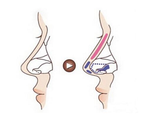 硅胶隆鼻的危害