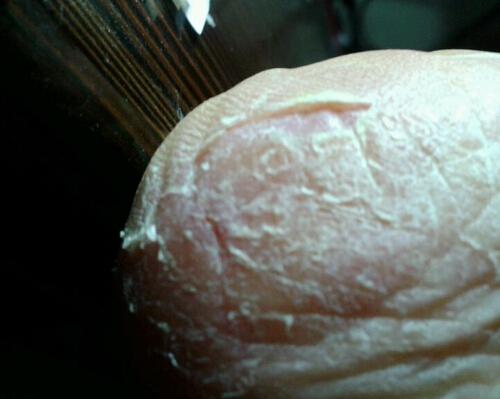 脚后跟干裂起硬皮是怎么回事