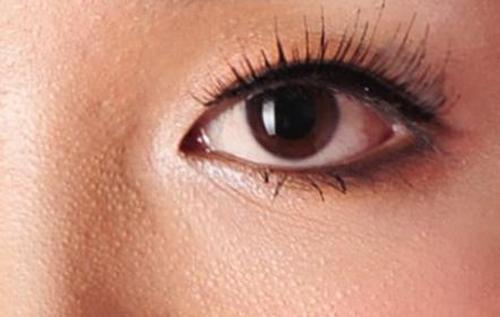 为什么眼周围长脂肪粒 7个原因你必须要知道