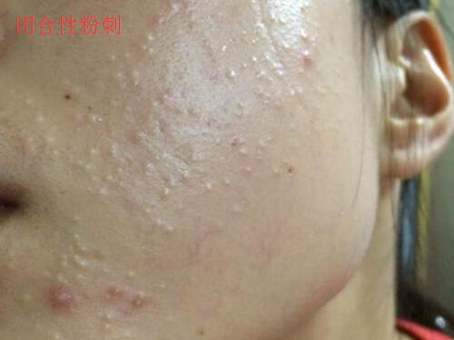 脂肪粒和闭合性粉刺的区别 闭口粉刺和脂肪粒的区别