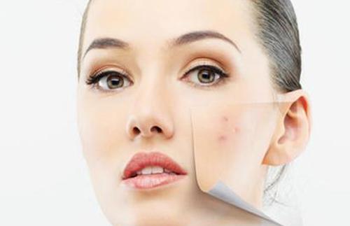 祛除痘印的最好方法 如何预防痘印