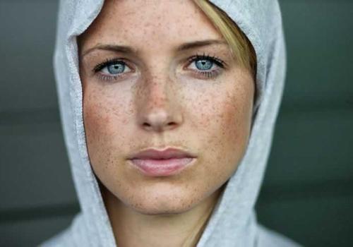 女人如何祛除黄褐斑 这些都要注意