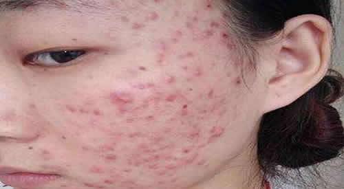 青春痘留疤能去掉吗