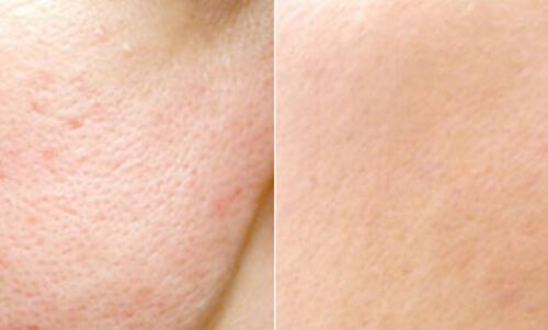 激光缩毛孔效果怎么样