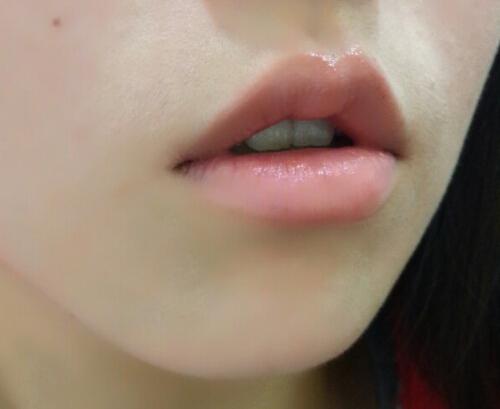 玻尿酸丰唇的危害