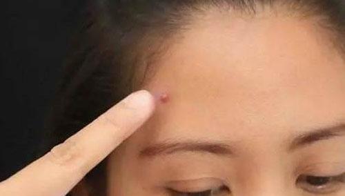 长痘痘要注意什么 有痘时不要经常摸脸