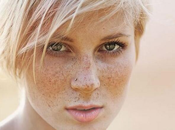 肝斑怎么调理简单办法 肝斑是怎样形成的