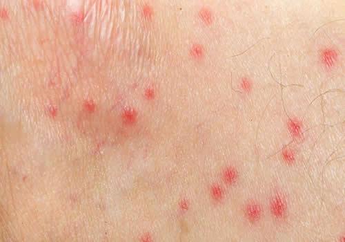 敏感性皮肤适合的面霜