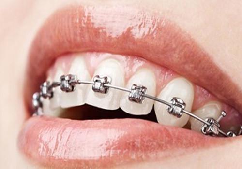 牙齿矫正后注意事项