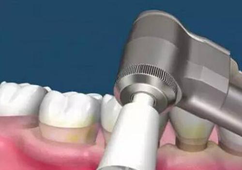 氟斑牙可以洗牙吗