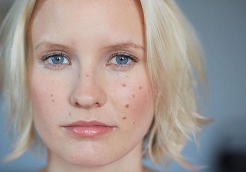 用粉刺针挑完痘痘要怎么护理 用粉刺针挑完痘痘后应该做什么