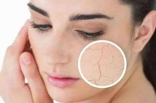 皮肤缺水会怎么样 缺水导致肌肤问题分析