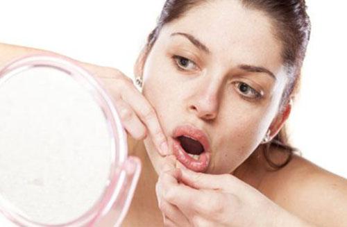 如何预防痤疮的形成 出现痤疮的原因