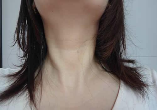 20岁有颈纹怎么办 想要去除20岁的颈纹，其实很简单！