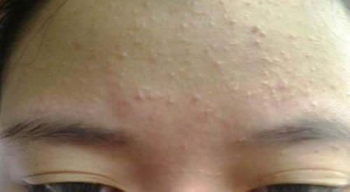 开口粉刺和闭口怎么区分