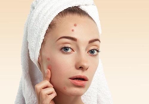 青春痘为什么长脸上