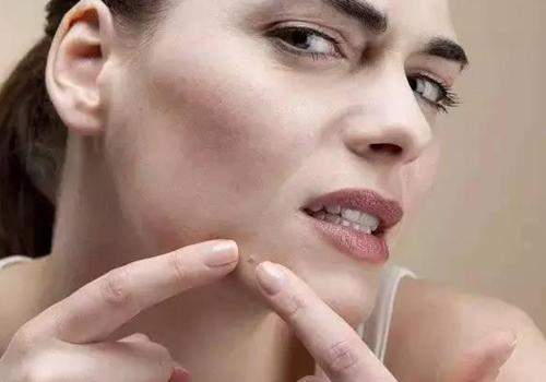 粉刺是怎么形成的 这些都会让你长粉刺