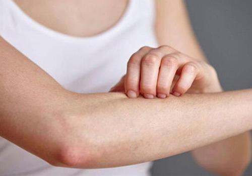 夏季皮肤过敏怎么办 8个方法有效防治皮肤过敏