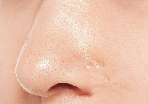 用粉刺针去黑头后怎么收缩毛孔 用粉刺针去黑头后怎么护肤