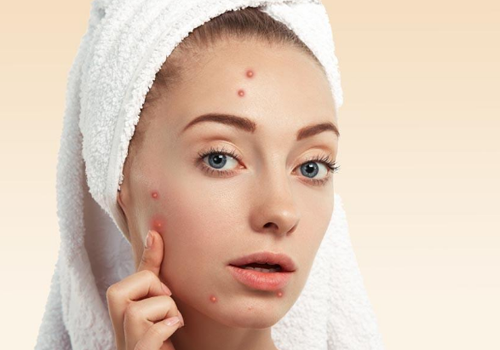 卸妆油可以去痘痘吗 跟痘痘粉刺说拜拜