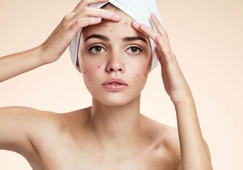 痤疮是由什么引起的 该如何预防痤疮