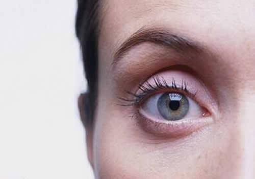 下眼袋水肿是什么原因 下眼袋水肿怎么办