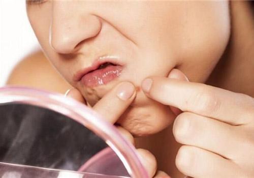 下巴长痘痘是什么原因 怎么调理能好