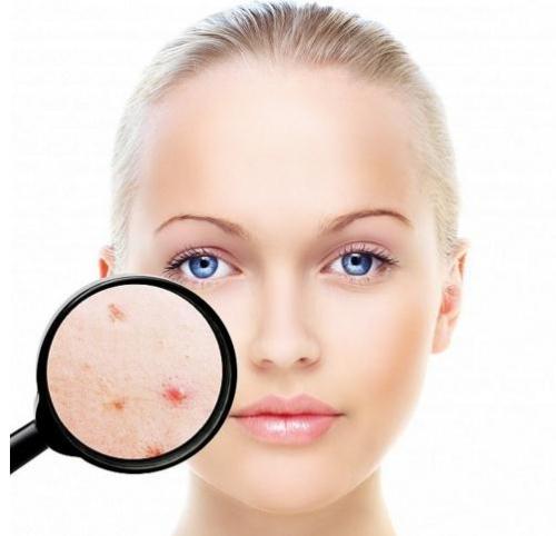 长痘痘了怎么消除 6款祛痘小妙招