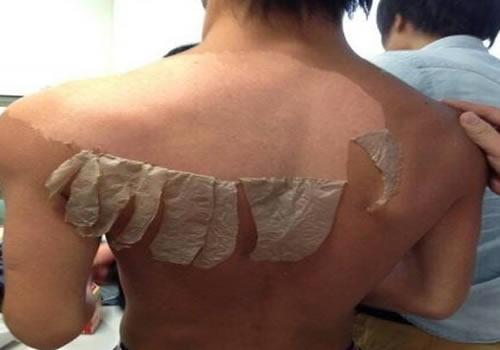 皮肤暴晒后脱皮怎么处理 五种方法三点注意事项你都学会了吗